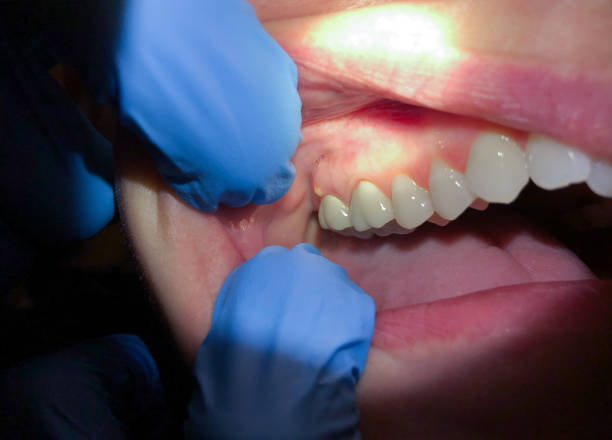 Best Knocked-Out Tooth (Avulsed Tooth) Treatment in Running Springs, CA